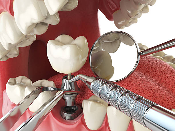 Best Knocked-Out Tooth (Avulsed Tooth) Treatment in Grape Creek, TX